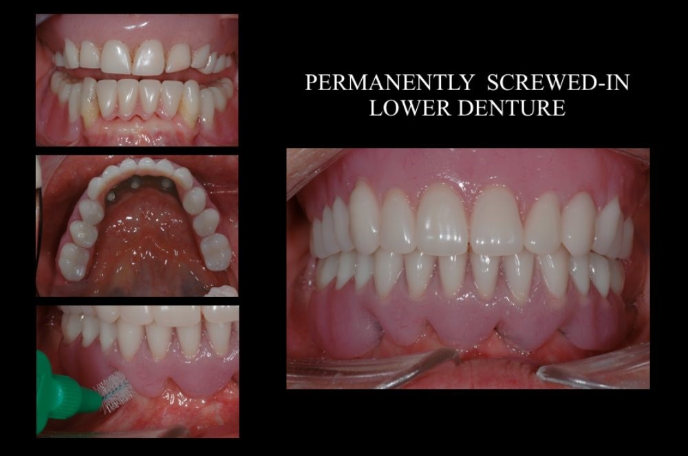 Young With Partial Dentures Burnsville WV 26335